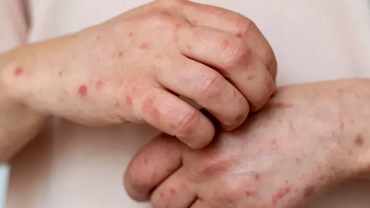 El Salvador sarampión